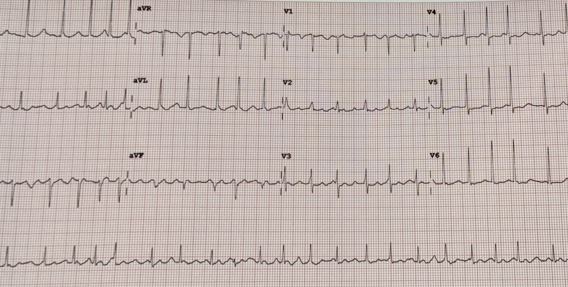 Example ECG showing atrial fibrillation (educational)